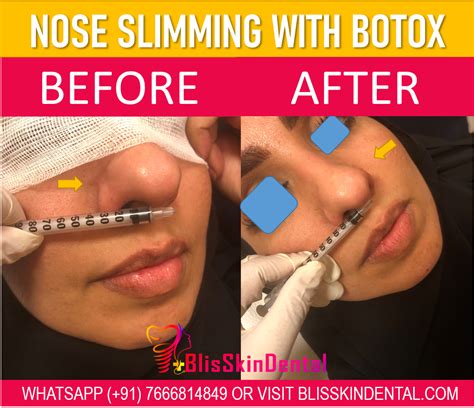 Botox for slimming wide nose in Bandra, Mumbai