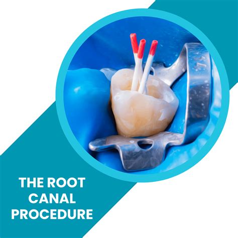 The Root Canal Procedure - How much is a root canal?