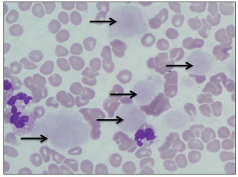 Plasma Cell Disorders | Oncohema Key