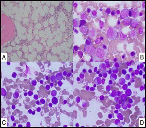 Elevated IgE Levels in A Patient with Myelodysplastic Syndrome | Biores Scientia