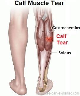 Gastrocnemius Tendon