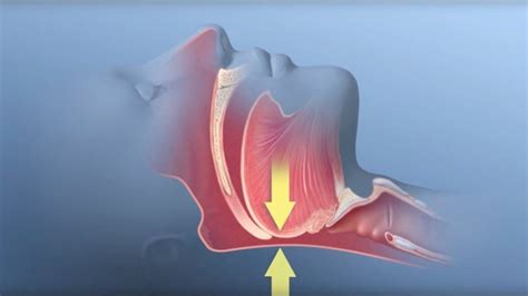 Obstructive Sleep Apnea | Westside Head & Neck