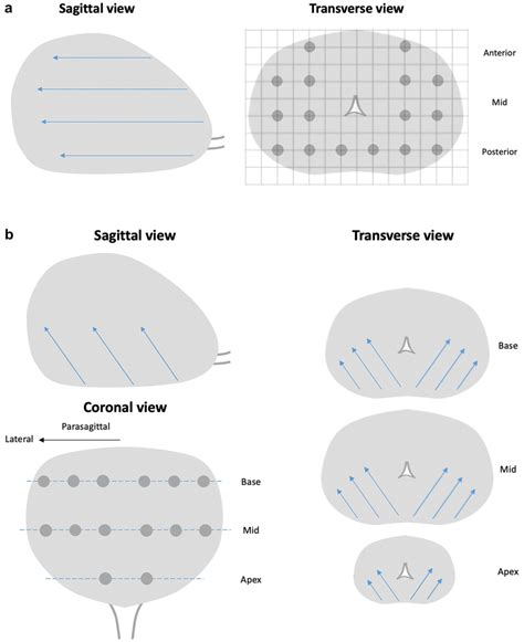 Prostate biopsy approach template diagrams. Diagrams of the templates... | Download Scientific ...