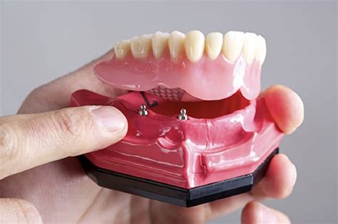 Implant-Supported Dentures (Overdenture)