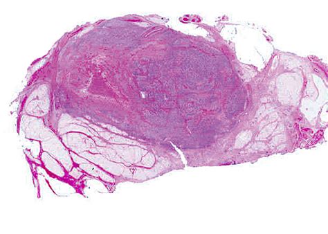 Pathology Outlines - Clear cell sarcoma