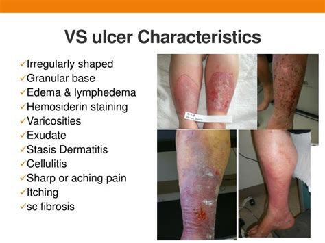 Venous Stasis Ulcer Stages