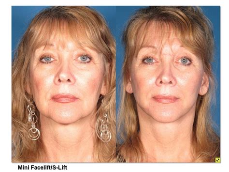 Mini Facelift/S-Lift Before & After Photos - Summit Plastic Surgery ...