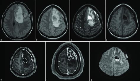 MRI findings (a) MRI T1 showing intraparenchymal abscess and edema... | Download Scientific Diagram