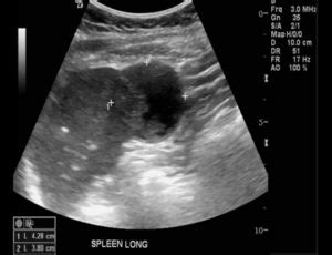 Splenic Abscess Ultrasound - radRounds Radiology Network