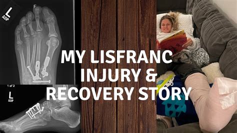 MY LISFRANC INJURY AND RECOVERY STORY (3 MONTH POST SURGERY UPDATE) - YouTube