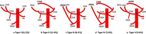 Schematic diagram of hepatic artery variation in the present study. a... | Download Scientific ...