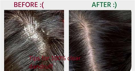 tips for 100% clear dandruff free hair