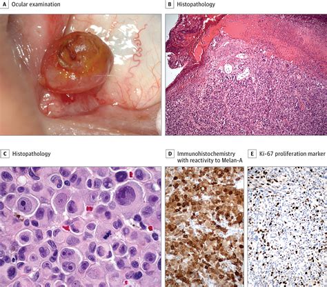 Malignant Melanoma Presenting as Pedunculated Lesion of the Caruncle ...