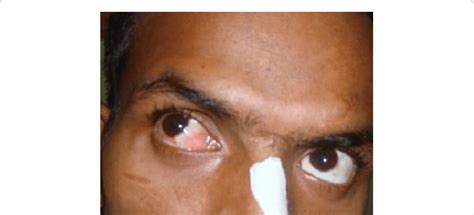 Ocular lesion after two cycles of combined regimen CHOP chemotherapy ...