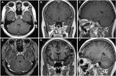 A T1-weighted magnetic resonance imaging (MRI) with gadolinium... | Download Scientific Diagram