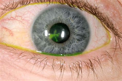 Corneal Ulcer (Keratitis) - Causes and Treatment -The Eye News