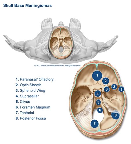 Types of meningiomas meningioma types – Artofit