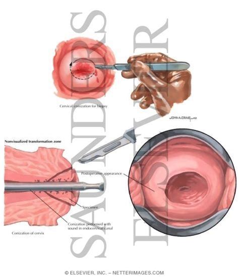 Cervical Conization (Cold Knife)