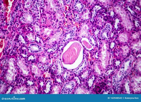 Histopathology Of Hypertensive Renal Disease, Light Micrograph Royalty ...