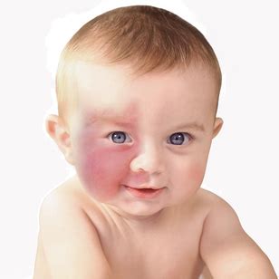 Laxmi Homeo Clinic: HAEMANGIOMA – VASCULAR BIRTHMARK treatment and remedies