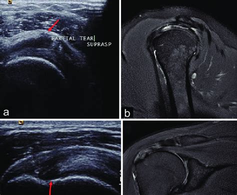 Illustrative image of supraspinatus tear with (a) demonstrating HFUS... | Download Scientific ...