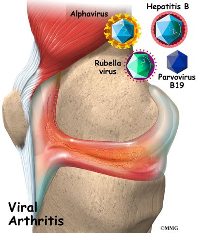 Viral Arthritis | Orthogate