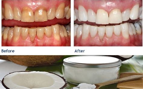 Coconut Oil: Your Answer To Better Oral Health And Whiter Teeth?