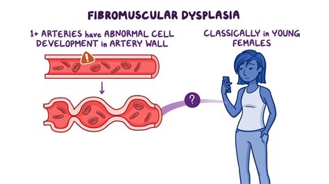 Fibromuscular dysplasia: Year of the Zebra: Video | Osmosis