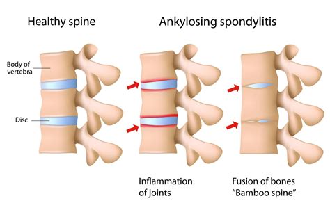 What Is Bamboo Spine? | New Jersey | Comprehensive Spine Care