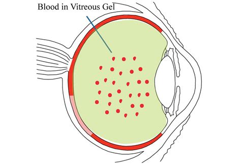 Vitreous Hemorrhage - Retina Eya Care, P.C.