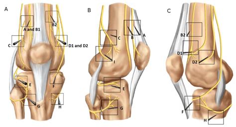 Technical Considerations for Genicular Nerve Radiofrequency Ablation: Optimizing Outcomes ...