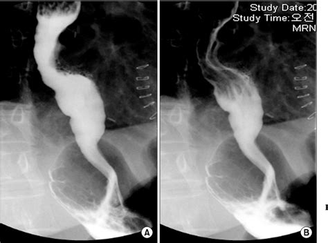 Esophageal Dysmotility