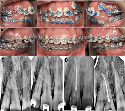 Necrotic Pulp With Crown Discoloration Associated With Orthodontic Treatment: A Case Report | Cureus