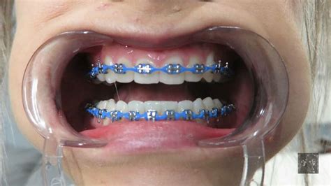 #braces #braceface #powerchain #metalbraces #girlswithbraces | Cute braces, Braces colors, Cute ...