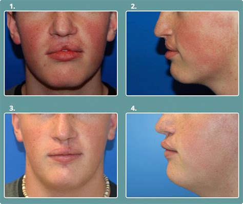 Before & After Cleft Lip & Palate - Michael Bateman, MD, PC