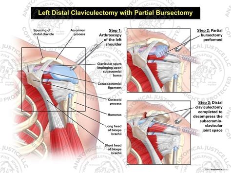 Left Distal Claviculectomy with Partial Bursectomy