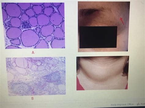 Solved HbA1C (Glycosylated hemoglobin test Laboratory 6 CASE | Chegg.com