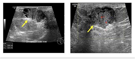 Pathology-proven papilloma with ultrasound findings of a solid lesion ...