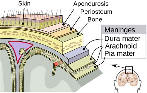 Epidural hematoma causes, signs, symptoms, diagnosis & treatment