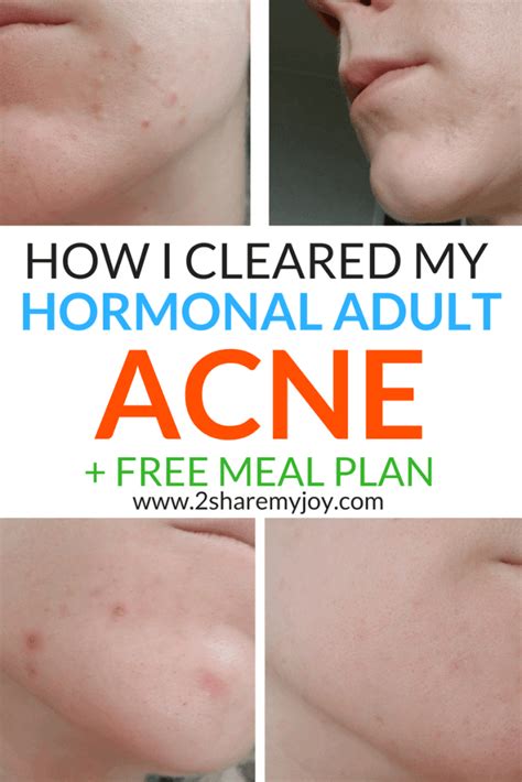 Hormonal Acne Diet - Open Diet