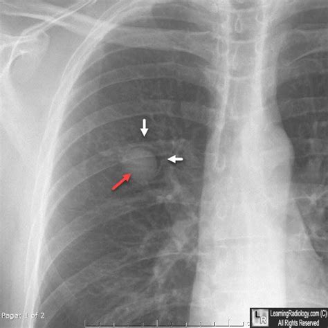 Aspergilloma Radiographer, Respiratory Therapy, Anatomy Study, Red Arrow, Med School, X Ray ...