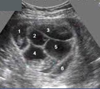 Sextuplets Ultrasound