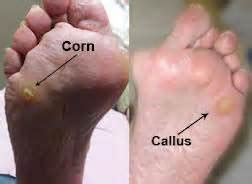 Corn | Common Foot Problems | South West Podiatry