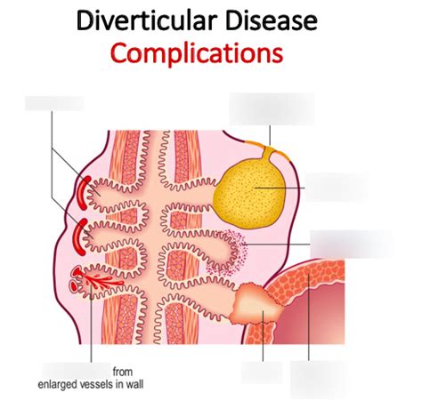 Diagram of Diverticular Disease: Complications | Quizlet