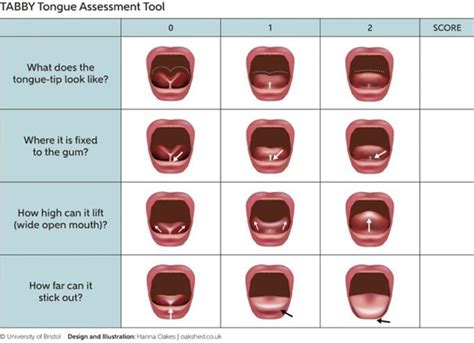 Tongue Tie – Ankyloglossia