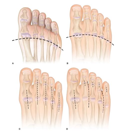 Master Techniques in Surgery: Foot Sparing-Amputations - DF Blog