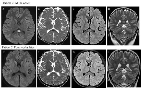 MRI performed at the onset for patient 2 showed focal high signal... | Download Scientific Diagram