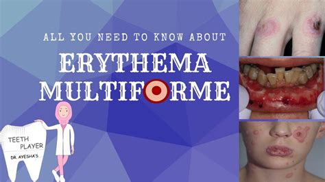 ERYTHEMA MULTIFORME |CLINICAL PRESENTATION|TYPES|DIAGNOSIS|TREATMENT| ANIMATED ORAL PATHOLOGY ...