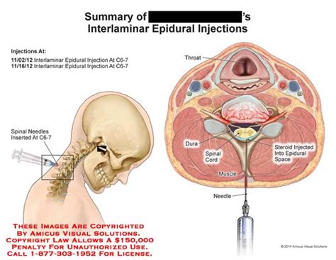 AMICUS Illustration of amicus,injection,summary,interlaminar,C6-7,spinal,needle,dura,spinal,cord ...