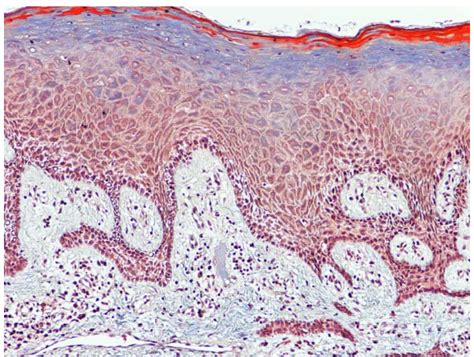 Gingival Hyperplasia Histology